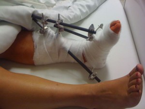 broken ankle my broken ankle